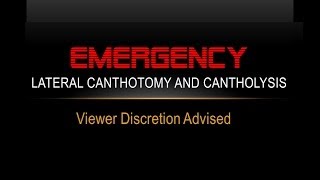 Emergency Lateral Canthotomy and Cantholysis [upl. by Vincentia]