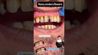 Look what Smoking does to your teeth [upl. by Kcaz]