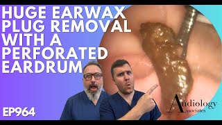 HUGE EAR WAX PLUG REMOVAL WITH A PERFORATED EARDRUM  EP964 [upl. by Chadabe]