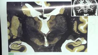 Thalamic Nuclei Brain Sections [upl. by Bradway]