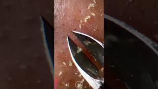 Skincare  Blackheads Removal 243 tweezers skincare blackheads blackheads [upl. by Nirrak]