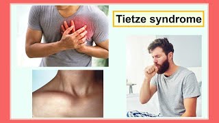 Tietze syndrome [upl. by Buchbinder]