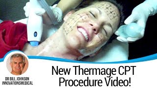 New Thermage CPT Procedure Video  Dr Bill Johnson [upl. by Colner]