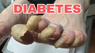 VERY THICK AND LONG DIABETIC TOE NAILS [upl. by Jarib]