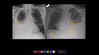 Radiografía de torax  Distinguir Hemothorax VS derrame pleural [upl. by Nitniuq631]