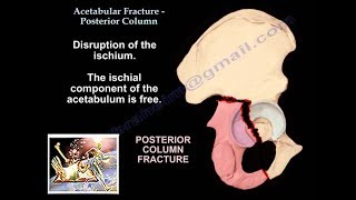 Acetabular Fracture Posterior Column Fracture  Everything You Need To Know  Dr Nabil Ebraheim [upl. by Silvano956]