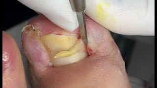 Double ingrown nails treatment [upl. by Capp]