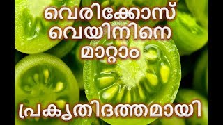 വേരികോസ് വെയിന്‍ മാറ്റാം വളരെ എളുപ്പത്തില്‍  PREVENTION OF VARICOSE VEIN NATURALLY [upl. by Verena932]