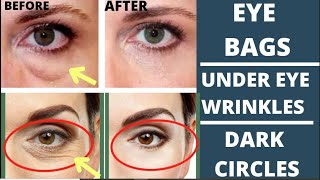 🛑 ANTIAGING FACE EXERCISES FOR EYE BAGS DARK CIRCLES EYE WRINKLES PUFFY EYELIDS DROOPY EYELIDS [upl. by Sherborne]