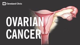 5 Warning Signs and Risk Factors of Ovarian Cancer [upl. by Croteau]