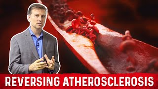 What causes Atherosclerosis amp How to Reverse Hardening of the Arteries – DrBerg [upl. by Tlok]