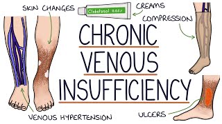 Understanding Chronic Venous Insufficiency [upl. by Aisat]