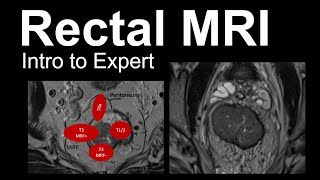 Rectal MRI Intro to Expert Rectal Cancer Staging [upl. by Baxie59]