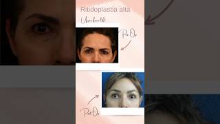 Lifting facial antes y después [upl. by Pedersen]