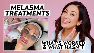 My Melasma Treatment Journey What Actually Worked to Treat Hyperpigmentation  Skincare Susan Yara [upl. by Volney555]