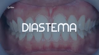 DIASTEMA  DENTAL CALIFORNIA [upl. by Annayi]