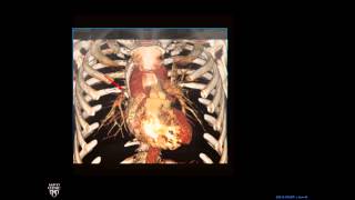 Plain Film Cardiac and Vascular Anatomy  Frontal Radiograph  Philip Araoz MD  Part 3 of 10 [upl. by Yer653]