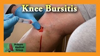 Pes Anserine Bursitis Knee Injection  Auburn Medical Group [upl. by Saibot]