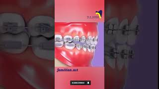 Intermaxillary Elastics in OrthodonticsdentistInermaxillaryelastic orthodonticsdentalesthetics [upl. by Jeanne]