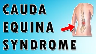 Cauda Equina Syndrome [upl. by Meirrak]