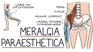 Understanding Meralgia Paraesthetica [upl. by Recha]