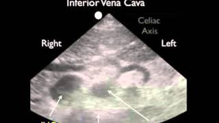 Procedimiento para realizar ecografías del área abdominal  Estudios de casos de la aorta [upl. by Akenihs44]