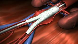 Aneurysma van de Aorta behandeld met endoprothese [upl. by Kulseth]