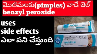 Benzoyl peroxide gel uses Telugupimplesacne treatment telugu [upl. by Irt]