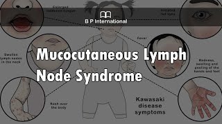 Mucocutaneous Lymph Node Syndrome [upl. by Erialc]