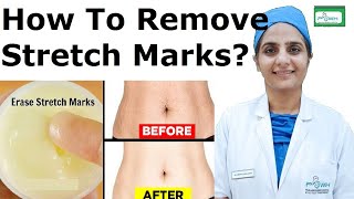 How To Remove Stretch Marks Permanently  स्ट्रेच मार्क्स जल्दी कैसे हटाए [upl. by Aira]