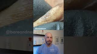 Ingrown hair frenzy ingrownhair dermreacts doctorreacts [upl. by Cirre]