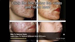 Acne Scar Treatment In The Philippines And AsiaWmv Scar Removal Philippines [upl. by Crispen]