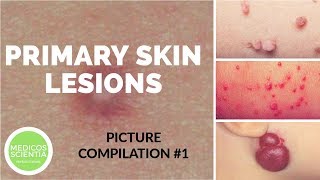 Primary Skin Lesions  Picture Compilation  Medicos Scientia [upl. by Doyle]