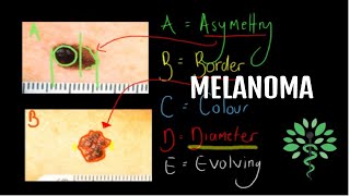 Melanoma  Symptoms signs diagnosis and management [upl. by Orella830]