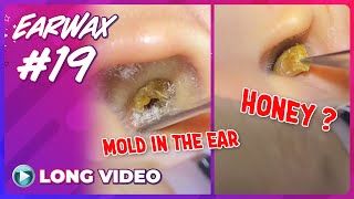 EP 19 Earwax ASMR Remove earwax from ears infected with fungus and yellow pus discharge [upl. by Obellia]