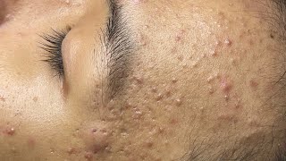 ACNE TREATMENT VU QUYNH MI  Blackheads Chin amp Nose Of Teen 2024 [upl. by Ribaj]