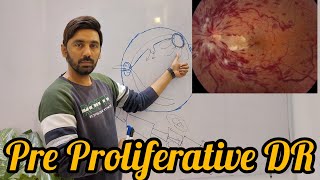 Pre Proliferative diabetic retinopathy [upl. by Ilke]