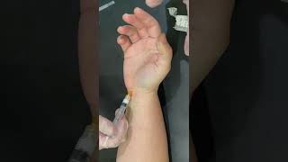 Right Carpal Tunnel Steroid Injection [upl. by Boice532]