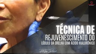 Técnica de rejuvenescimento do lóbulo da orelha com ácido hialurônico [upl. by Vez314]