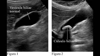 VESÍCULA BILIAR VALORACIÓN ECOGRÁFICA [upl. by Hannus887]