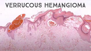 Verrucous Hemangioma pathology dermpath dermatology dermatopathology [upl. by Enirehtahc]