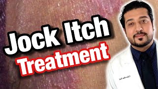 How to Treat Jock Itch Fast  Jock Itch Treatment Causes and Prevention 2021 [upl. by Ydrah]