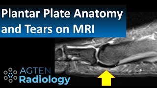 How to Assess Plantar Plate Anatomy and Tears on MRI [upl. by Danice]