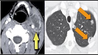 Neck Spotters 15 case radiology in 15 minutes radiopedia medicalimaging radiography radiology [upl. by Carnahan]