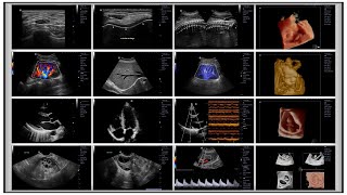 Enhancing Diagnostics Advanced Ultrasound Imaging for GI Applications [upl. by Eiramanig]