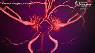 Prograsion of moya moya syndrome oleh cincinati children hospital [upl. by Anwaf817]