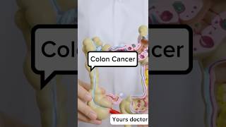 Colon cancer  All about colon cancer coloncancer coloncancerawareness coloncancersurvivor [upl. by Snehpets]