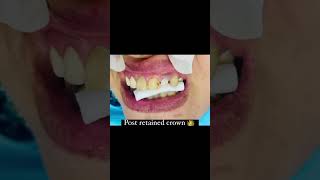 dentistry endodontist endodoncia conservative dentist post fixedcrownrestoration [upl. by Romeon747]