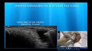 Ultrasound Guided Aspiration and Injection of a Hoffas Fat Pad Ganglion [upl. by Sydel]