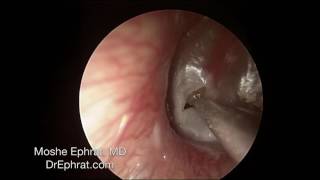 ENDOCSOPIC MUCOID OTITIS MEDIA DRAINAGE [upl. by Renick]